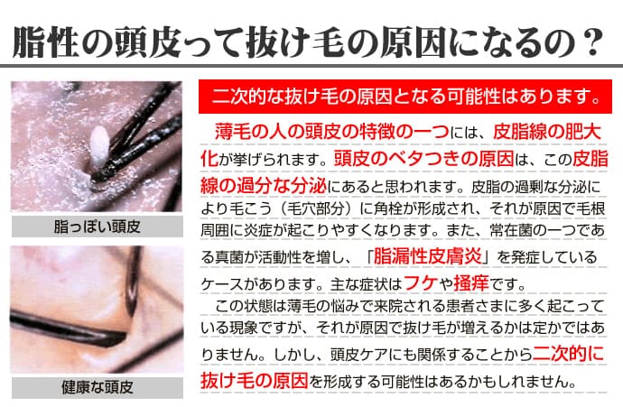 脂性の頭皮って抜け毛の原因になるの?